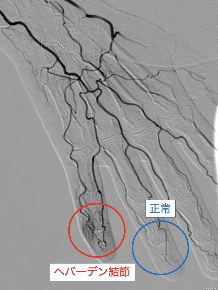 モヤモヤ血管とは